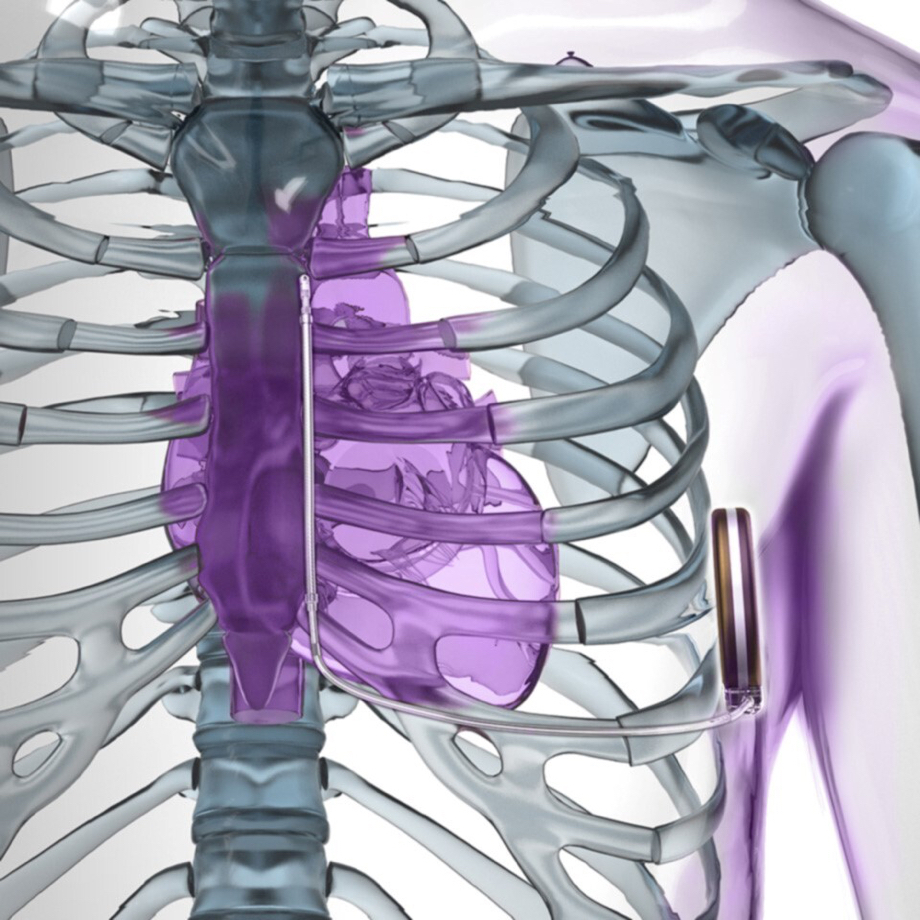 EMBLEM MRI SICD™ System (Subcutaneous Implantable Defibrillator) Boston Scientific
